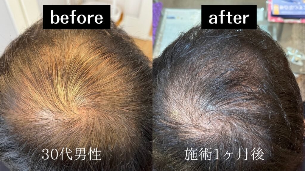 プロセルセラピートリートメント施術前後の比較写真(30代男性・施術1ヶ月後)。頭頂部の発毛変化を示す