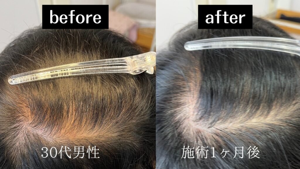 プロセルセラピートリートメント施術前後の比較写真(30代男性・施術1ヶ月後)。分け目付近の毛量変化を示す